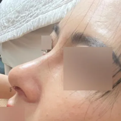 做了無植入物的隆鼻手術^^