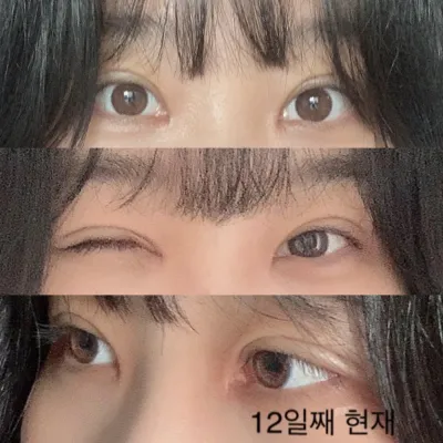 眼部重修手術，非常滿意的真實後記