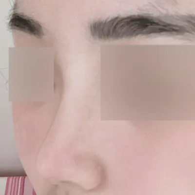 做完短鼻+功能性隆鼻手術已經3個月了！