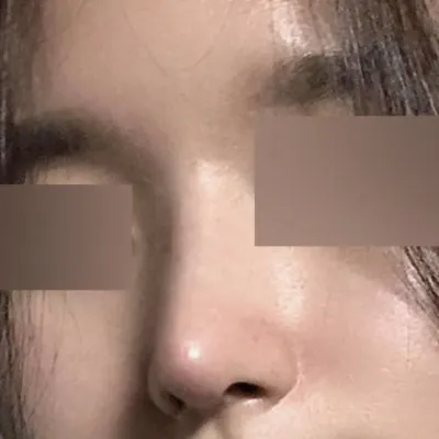 做了直鼻線手術已經兩個月了