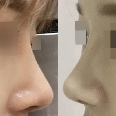 做完隆鼻手術已經三個月了