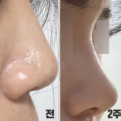 做完隆鼻手術一個月了！