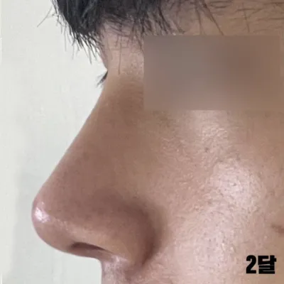 手術時一起做了鼻翼縮小，很滿意。