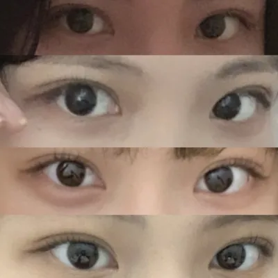 （自然沾黏 眼型矯正 開眼頭）手術後4個月