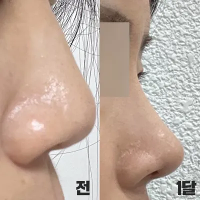 做了直鼻感覺的隆鼻手術一個月