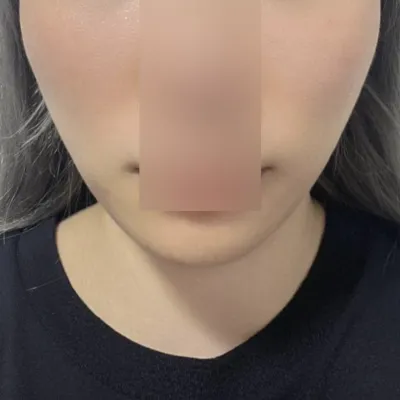 解決了一直困擾我的法令紋~