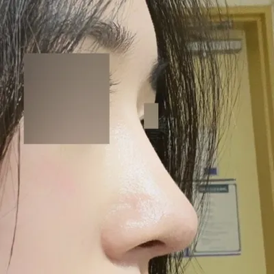 在沈正煥院長那裡做了手術已經4個月了！