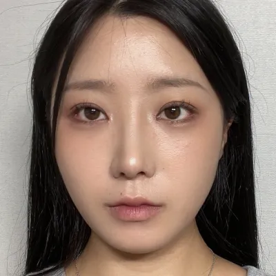 手術滿一個月了～