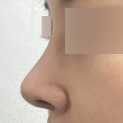 做了捏鼻子的重新手術