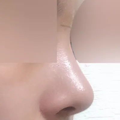 鼻部手術後3個月後記