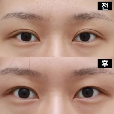 做了香腸眼重修手術和眼部矯正!