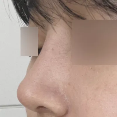 隆鼻手術一個月後成功了！