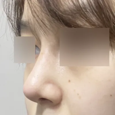 在維沃斯整形外科做了鼻部修復手術，術後一個月的感想~! 