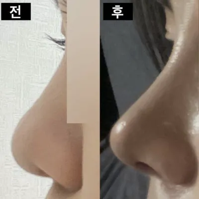 做完隆鼻手術已經1個月了 ㅎ