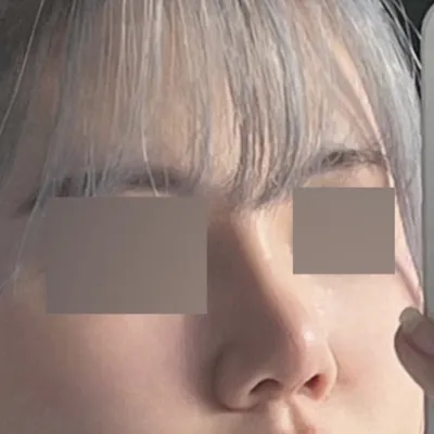 不用修圖也很漂亮的鼻子，太感動了+非常感謝院長！