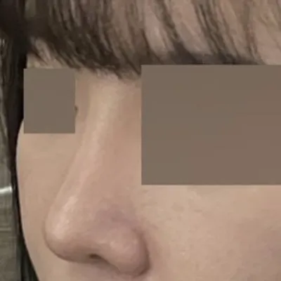 手術已經過去4個月了！！ 哈哈