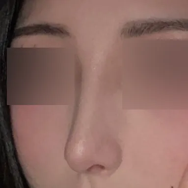 因為鷹鉤鼻壓力很大，下定決心做了手術！！