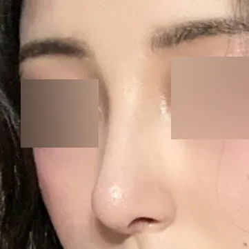 手術後一個月了。