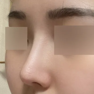 漂亮地做了鼻炎手術已經6個月了