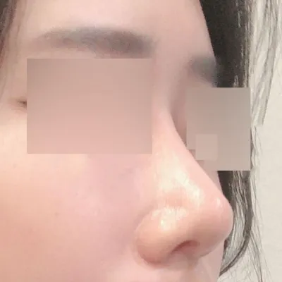 我的鼻子做完半年後記！