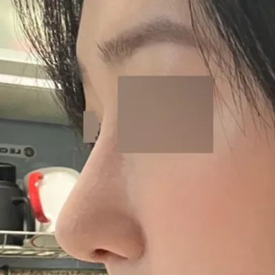 第一次做鼻部手術，到處 고민하다 終於做了鼻子手術。