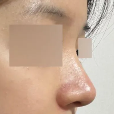 做完隆鼻手術已經半年啦ㅎㅎ