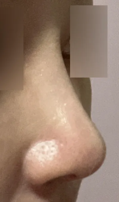 手術已經過去6個月了