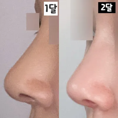 維沃斯整形外科 鼻部重修手術後2個月的感想