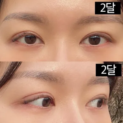 做了雙眼皮重修和眼型矯正。