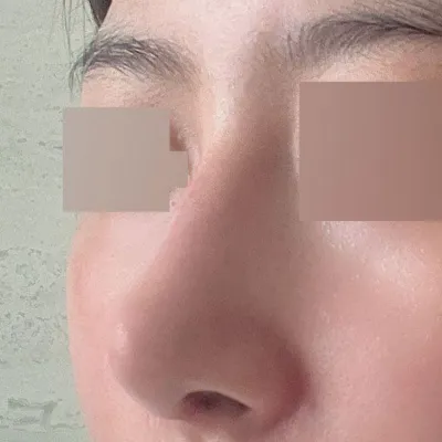 感謝徐承祖院長，讓我的鼻子重獲新生！