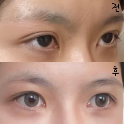 在江南站 Weavers 整形外科做眼部重修手術已經兩個月了！