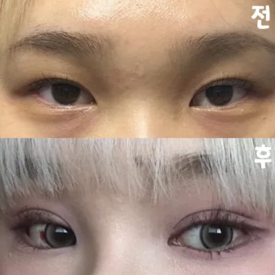 對手術非常滿意，大家都去做韋弗斯吧！！