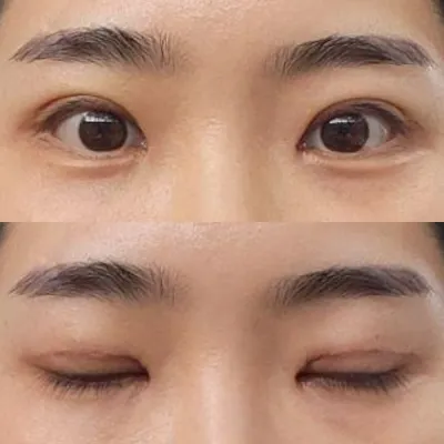 我做眼部重修手術已經一週了