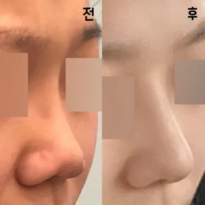 我也終於得到了我夢寐以求的鼻子！！