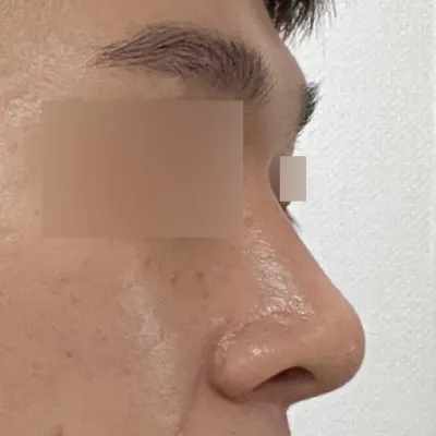 給徐承祖院長做鼻子手術已經2個月了。