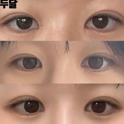 給沈正煥院長做了眼鼻手術兩個月後的後記