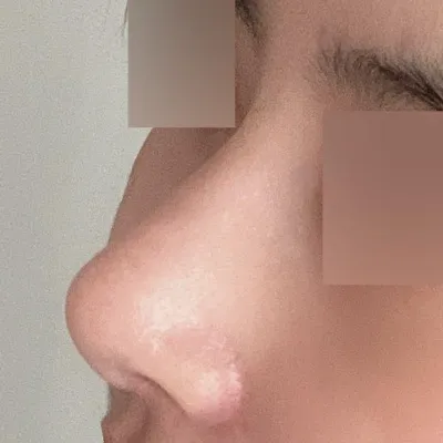 現在好像完全和蒜頭鼻告別了哈哈