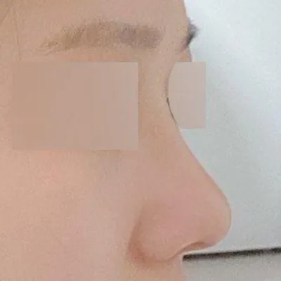 鼻樑挺起來後，側臉也變漂亮了，立體感也增強了！