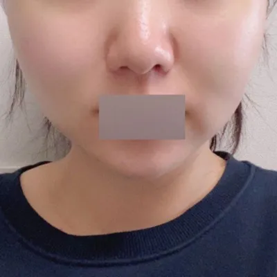 沈正煥院長nim的手法非常細膩