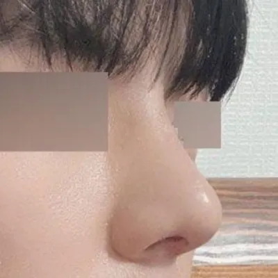 做了鼻炎手術，也算是自我管理