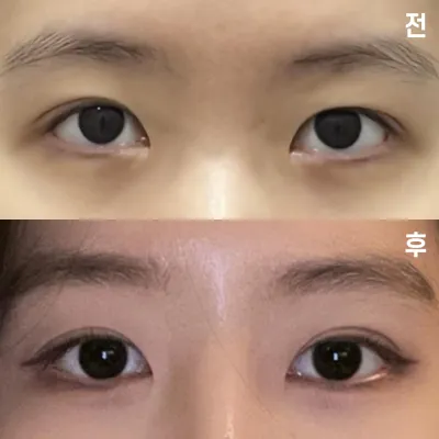 在維沃斯整形外科做手術已經1個月了~! 