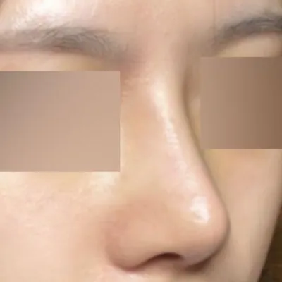 雖然是第一次手術，但感覺非常成功