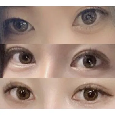 眼部重修手術自然地成功了！