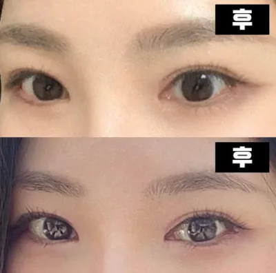 如果您正在為雙眼皮手術而苦惱，我強烈推薦這家醫院~