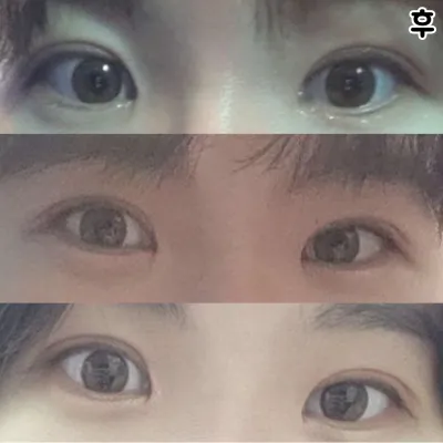 因為眼睛下垂，一直沒有自信，手術後找回了自信ㅠㅠㅠㅠ