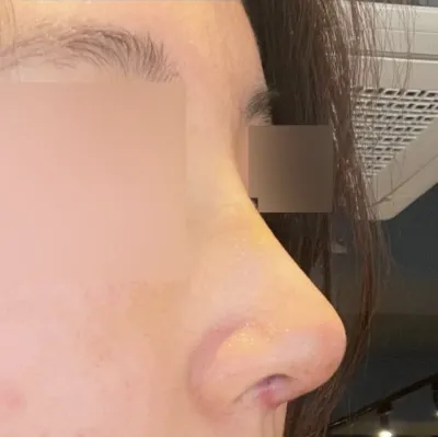 諮詢很詳細，而且非常關心術後恢復