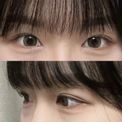 因為仔細地諮詢，所以我決定在Weaver整形外科做手術！