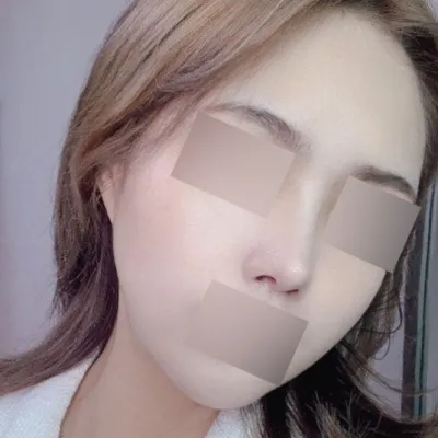 拉提+鼻重修4個月後記