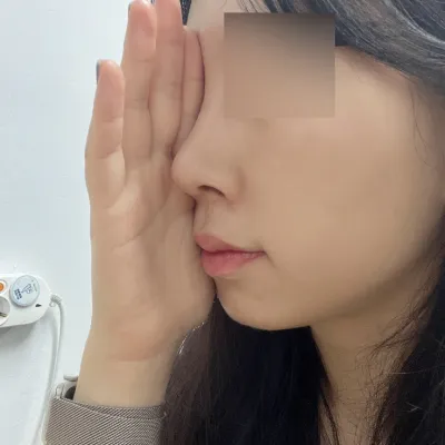 隆鼻手術後3週心得分享 :)