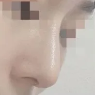 沒有假體也擁有了像吳漣序一樣漂亮的直半Line鼻子!